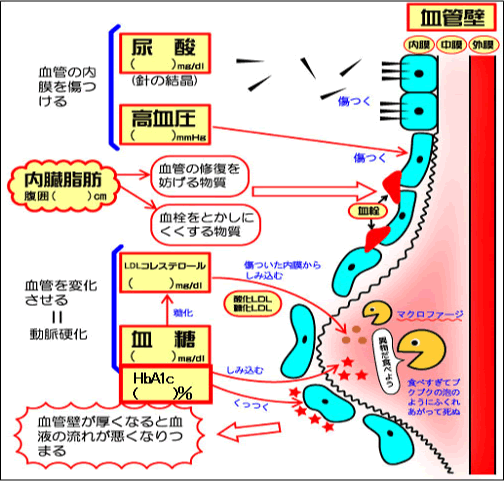 動脈硬化